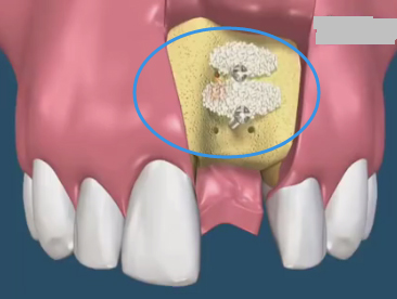 缺牙部位牙槽骨骨粉移植位置展示