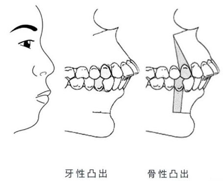 龅牙矫正可以改善凸嘴吗？骨性突嘴和牙性凸嘴有什么区别