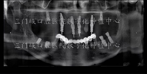 三门峡口腔医院哪位医生技术好?听说张松涛做种植牙不错!