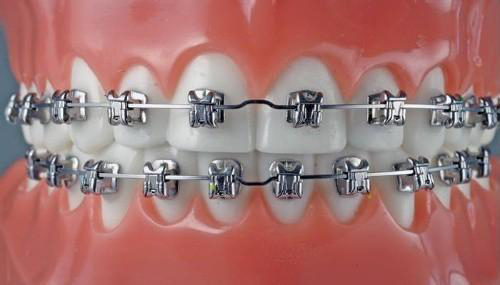 金属托槽牙齿矫正模型
