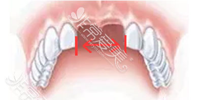 门牙缺失适合种植牙图片