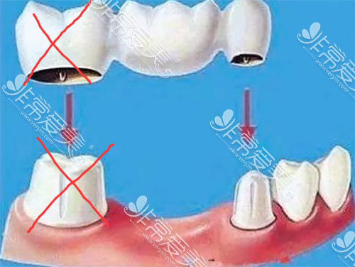 烤瓷牙连桥冠照片