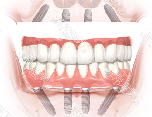 全口种植牙动画图片