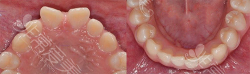 牙齿矫正前后上下牙齿情况