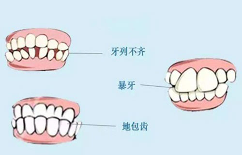 惠州牙齿矫正地包天需要多少钱?分享惠州矫正牙齿费用!