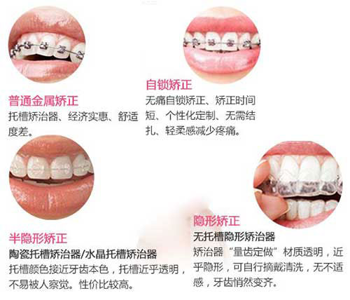 牙齿矫正的方式