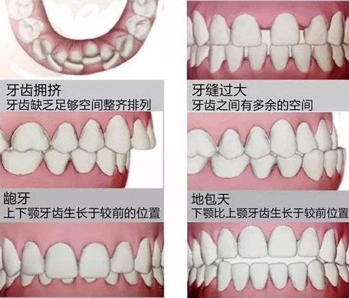 惠州牙齿矫正地包天需要多少钱?分享惠州矫正牙齿费用!