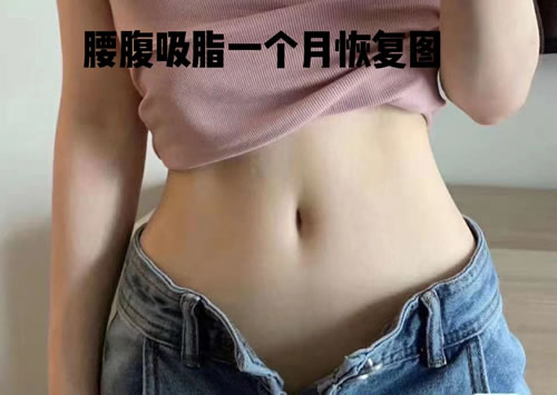 愛貝思醫(yī)院吸脂一個(gè)月后的圖片