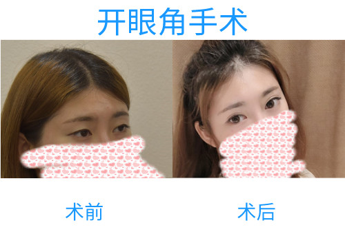 广州开眼角多少钱？通过案例看看华美和美莱效果怎么样？