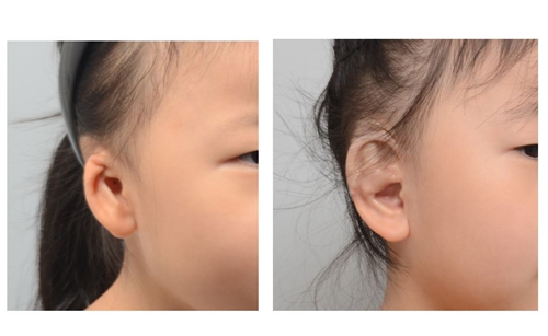 profile普罗菲耳整形外科耳畸形矫正手术案例