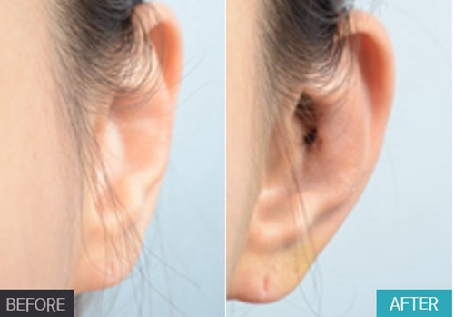 profile普罗菲耳整形外科贴发耳矫正效果