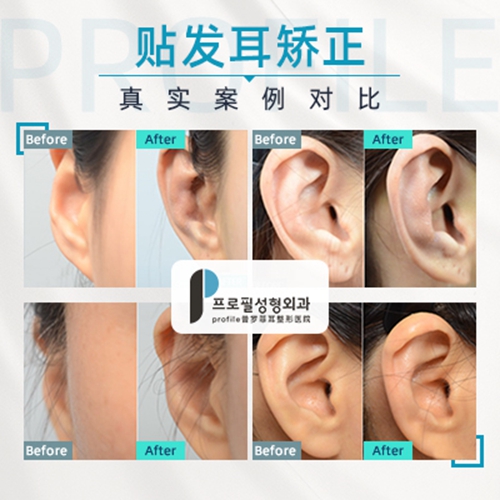 韩国profile普罗菲耳整形外科贴发耳矫正手术效果怎么样？