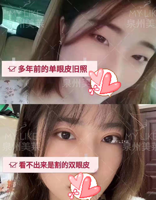 泉州美莱华美整形双眼皮前后对比照片