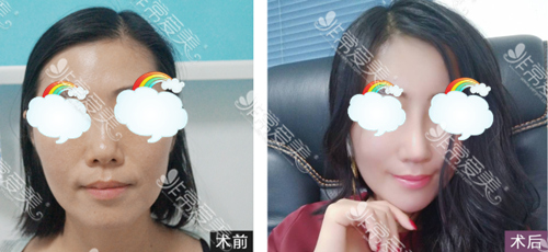 深圳军科医疗美容4D打印隆鼻案例