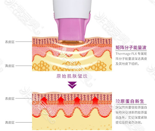 热玛吉工作原理