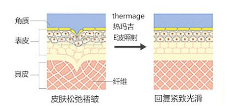 热玛吉使用过后图