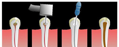 根管治疗的过程示意图