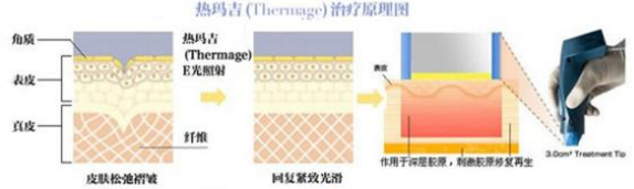 热玛吉原理图