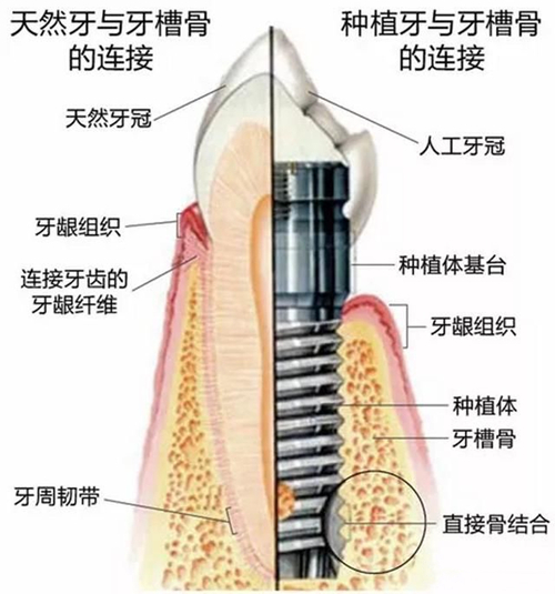 種植牙功能與天然牙功能比較圖