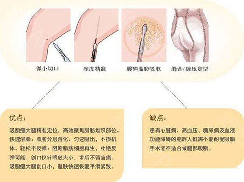 在惠州一般吸脂的费用是多少?附全身抽脂的价格详情!