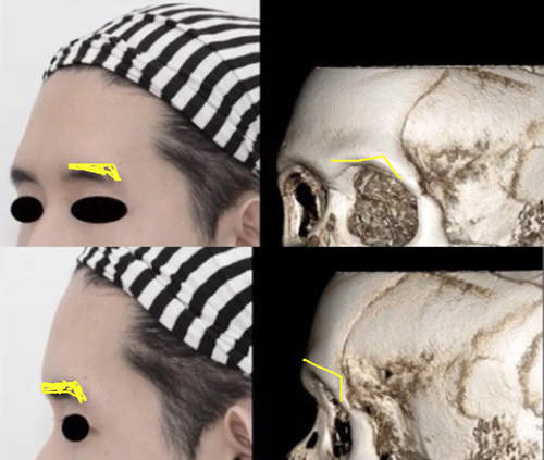 隆眉弓手術(shù)術(shù)前設(shè)計(jì)ct