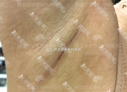 韩国芭堂整形假体隆胸腋下乳房下皱襞切口疤痕图片分享