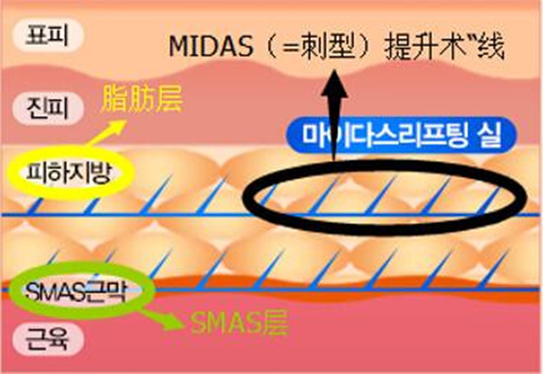 同是医美抗衰 热玛吉热拉提埋线分别适合哪个年龄段的人?