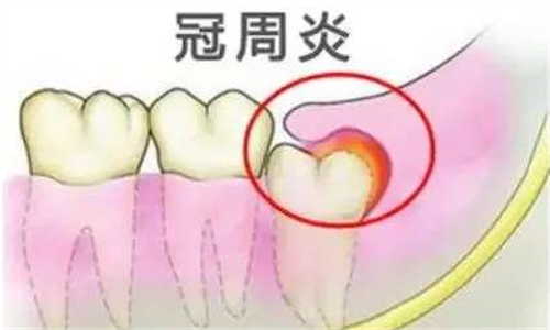 3,生长位置不正刚萌出的智齿因为生长空间不足,会抢占周围牙齿的