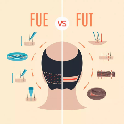 FUT植发和FUE植发的区别