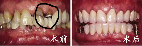 济南维乐口腔种植牙案例前后对比