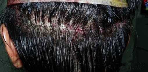 植发后伤口感染
