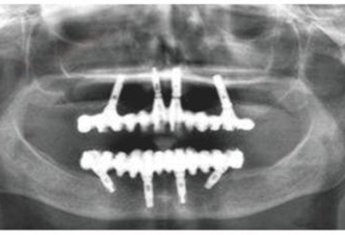 allon4种植牙CT片