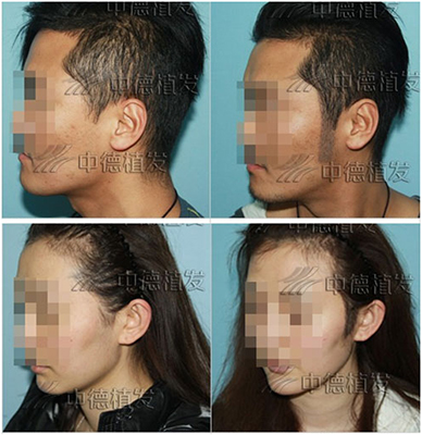 北京中德植发医院鬓角植发对比照片