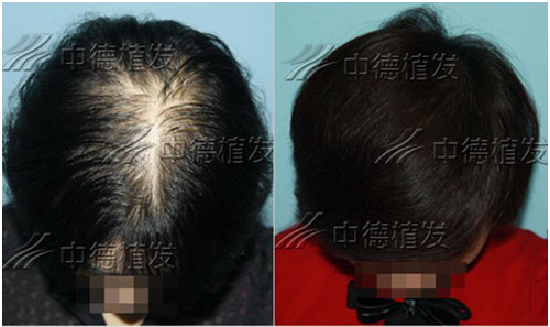 北京中德植发医院毛发移植对比照片