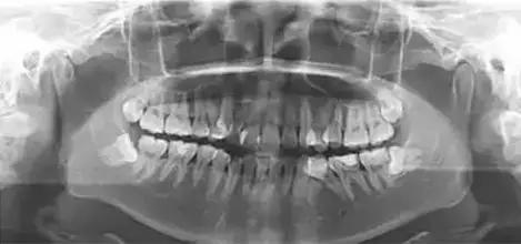 种植牙术前检查拍CT图