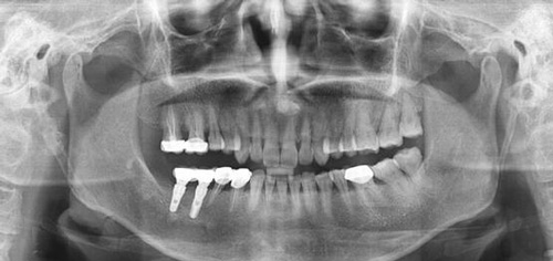种植牙术后检查拍CT图