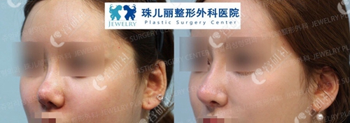 韩国珠儿丽尹容逸隆鼻术前术后对比