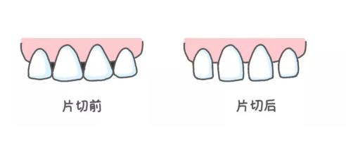 牙齿片切前后