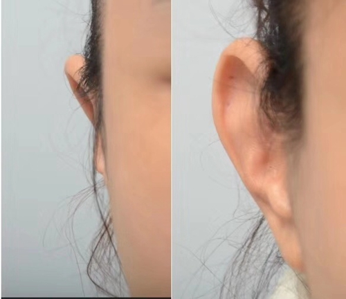 韩国profile普罗菲耳整形外科贴发耳矫正前后效果对比