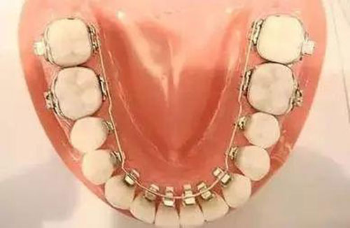重庆牙博士口腔医院舌侧矫正器示意图
