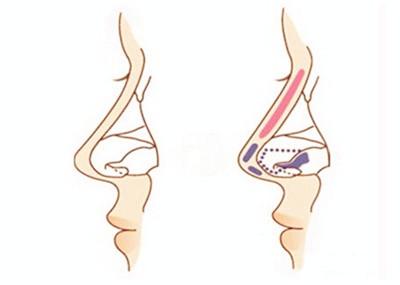 復(fù)合隆鼻示意圖