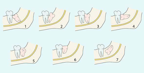 智齒的不同情況
