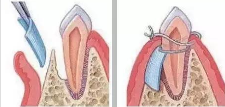种植牙骨膜