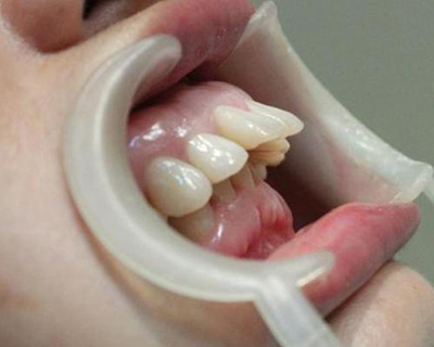 齿性牙齿前突