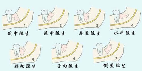 智齿的各种形态示意图