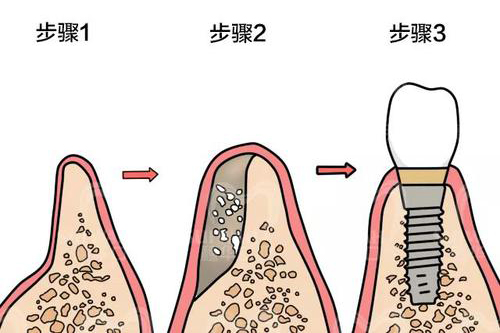 種植牙骨粉填充步驟