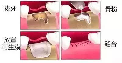種牙骨粉過(guò)程