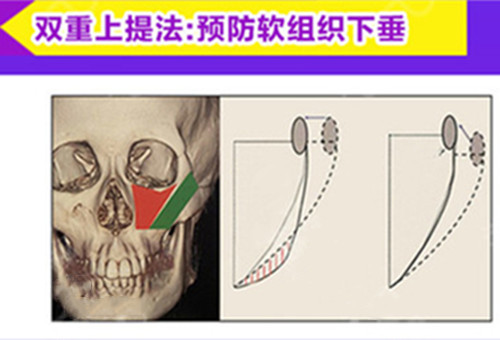 广州做颧骨缩小手术哪家好？颧骨术后面部下垂如何避免？