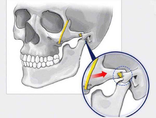 颧骨缩小手术的钛钉固定位置