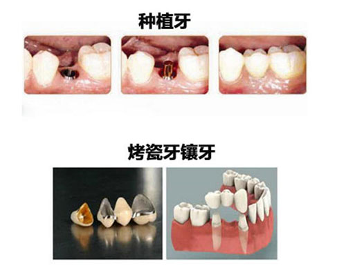 种植牙和镶牙之间的区别
